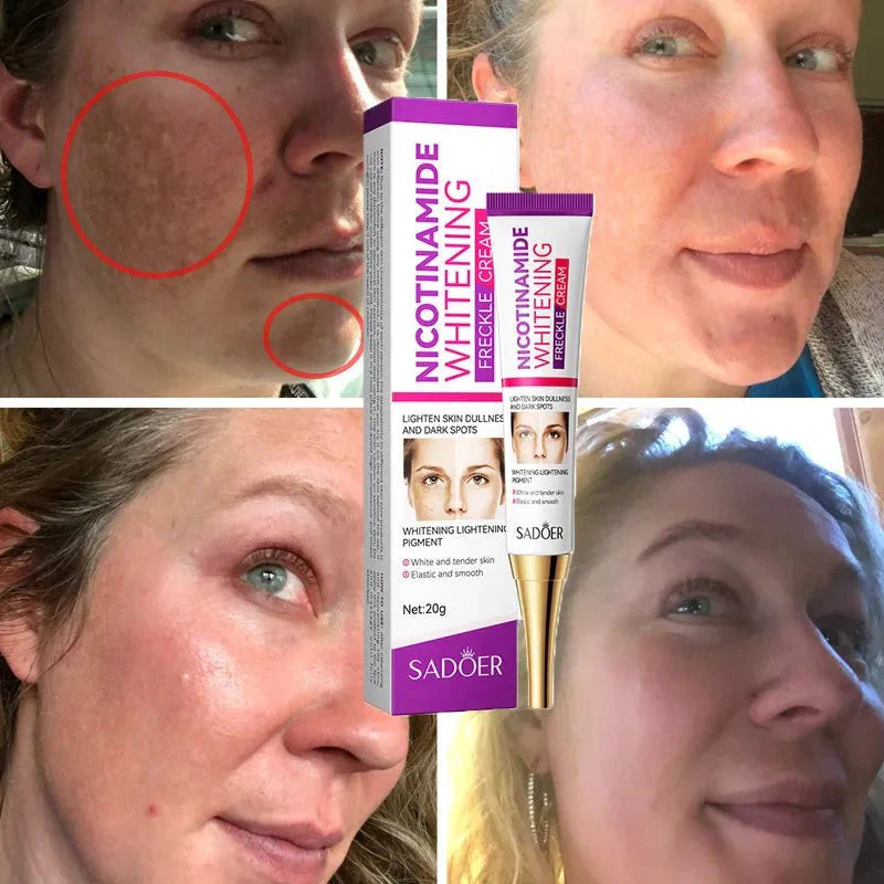 CREMA ELIMINADORA DE MANCHAS - ORIGINAL®️ Noah Tienda