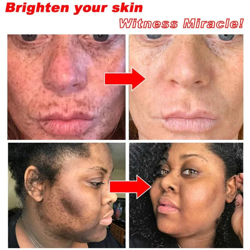 CREMA ELIMINADORA DE MANCHAS - ORIGINAL®️ Noah Tienda