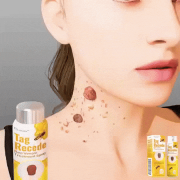 MEGA PROMOCION! 2x1!  Eliminador de Verrugas-Tag Recede® La Yupi!