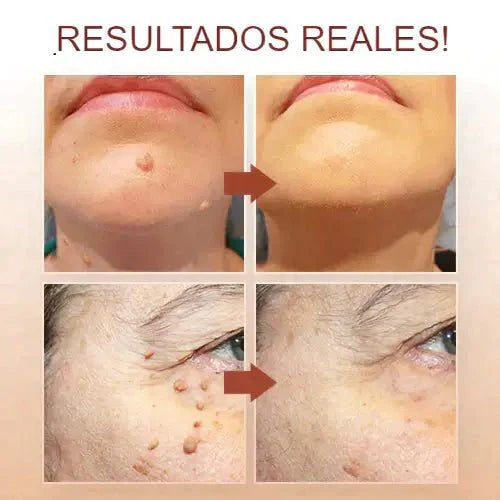 Kit Eliminador de Verrugas ⭐⭐⭐⭐⭐ Noah Tienda