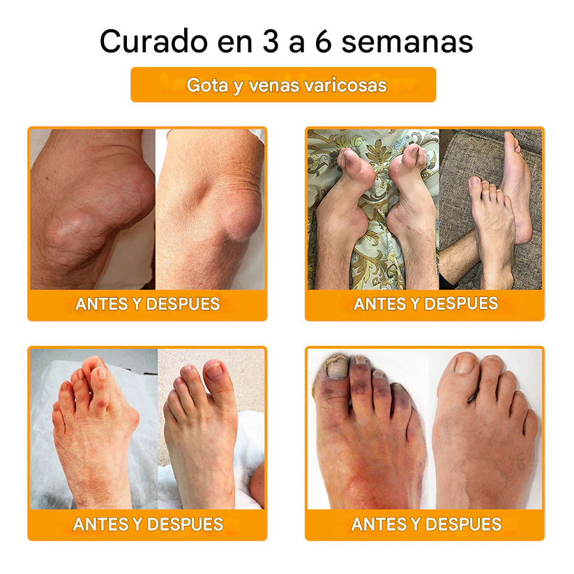 PROMO 2x1 - Crema Para La Curación De Huesos Y El Alivio Del Dolor Con Bótox Dankat