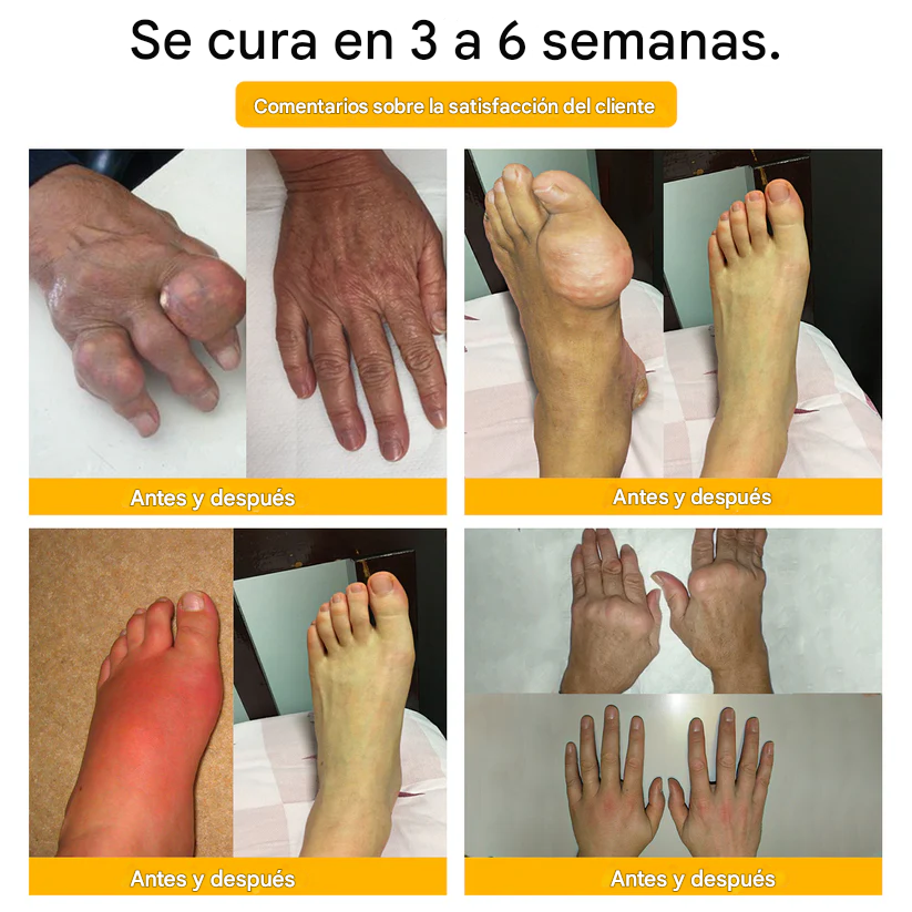 PROMO 2x1 - Crema Para La Curación De Huesos Y El Alivio Del Dolor Con Bótox Dankat